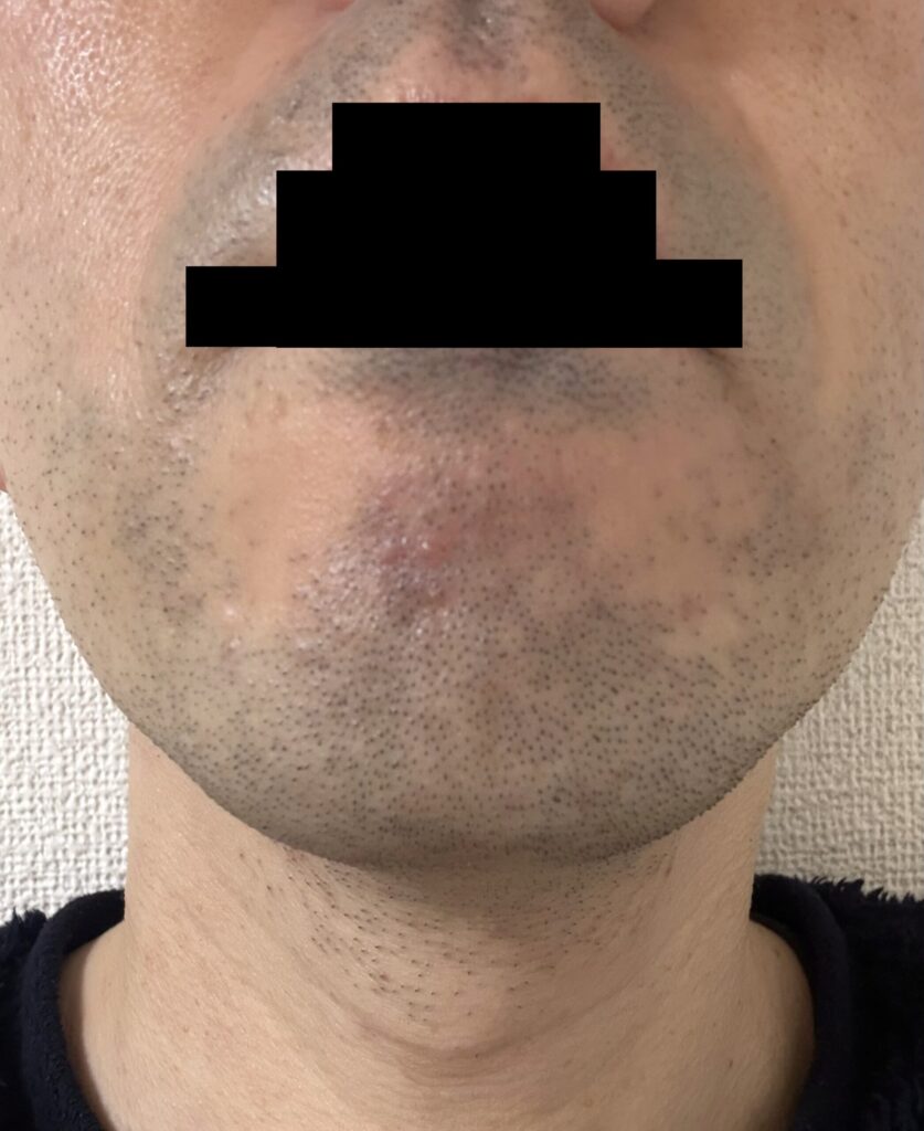 ヒゲ脱毛初回 施術後 青ヒゲの状態