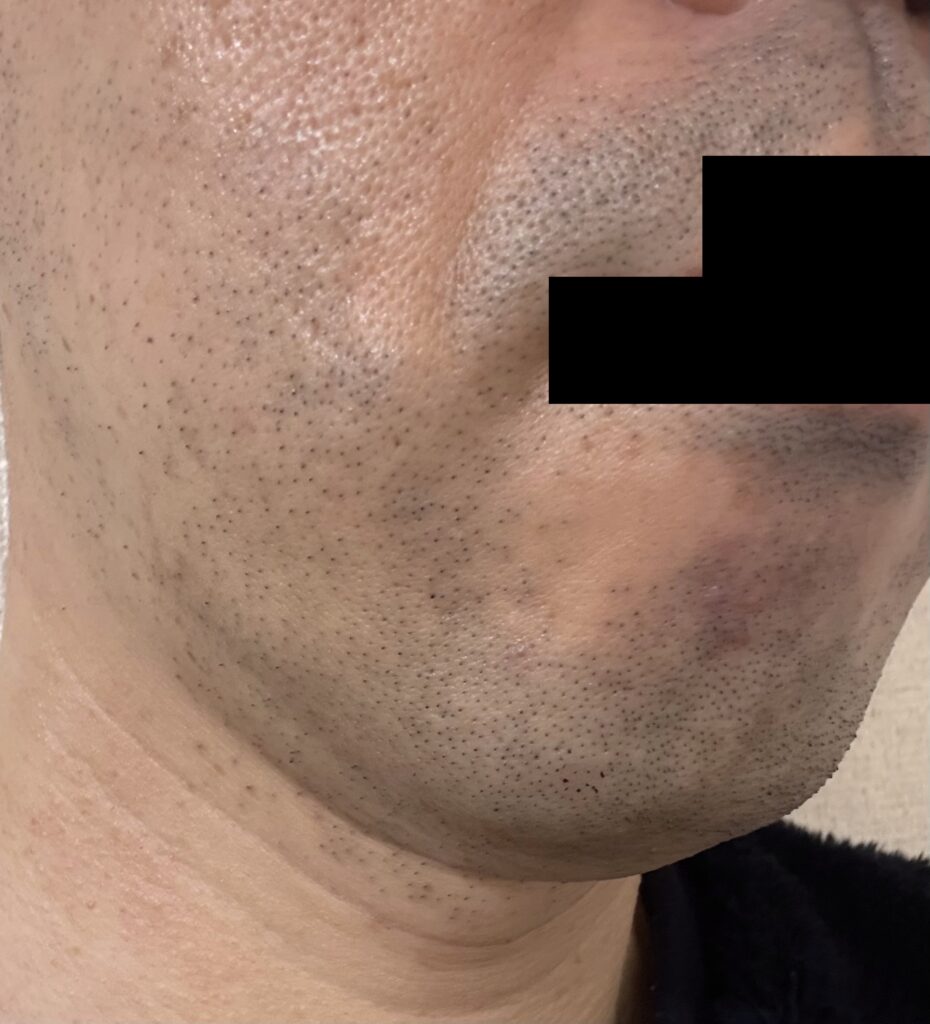 ヒゲ脱毛初回 施術後 青ヒゲの状態