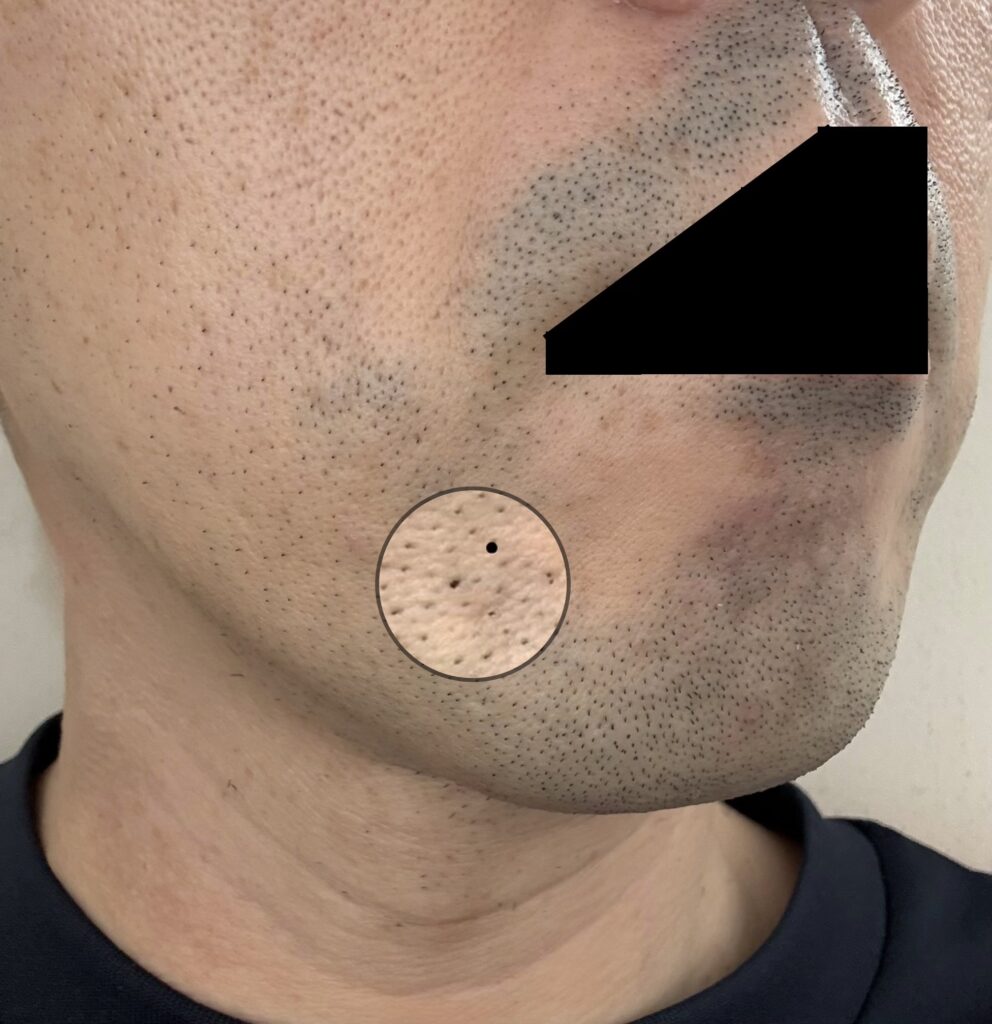 初回から1ヶ月後、2回目の施術前 横