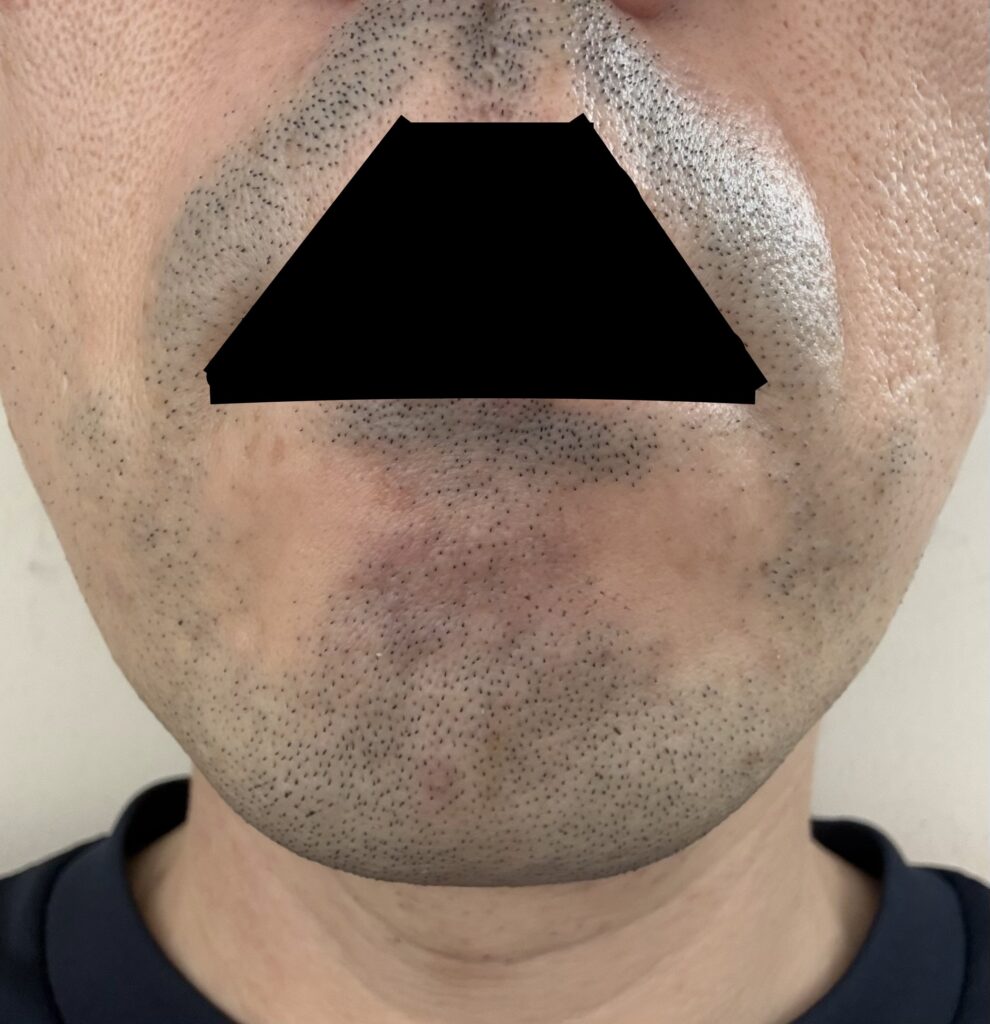 初回から1ヶ月後、2回目の施術前 正面