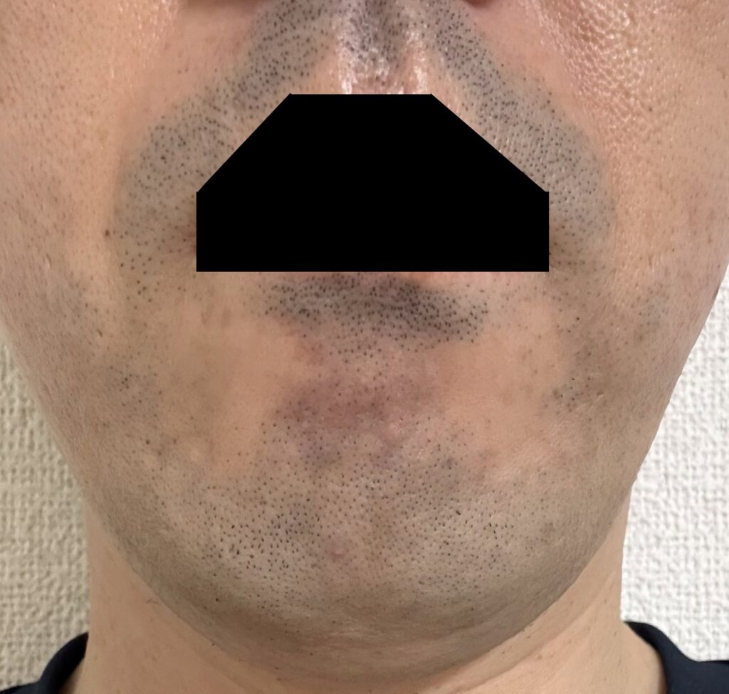 2回目の施術後 正面