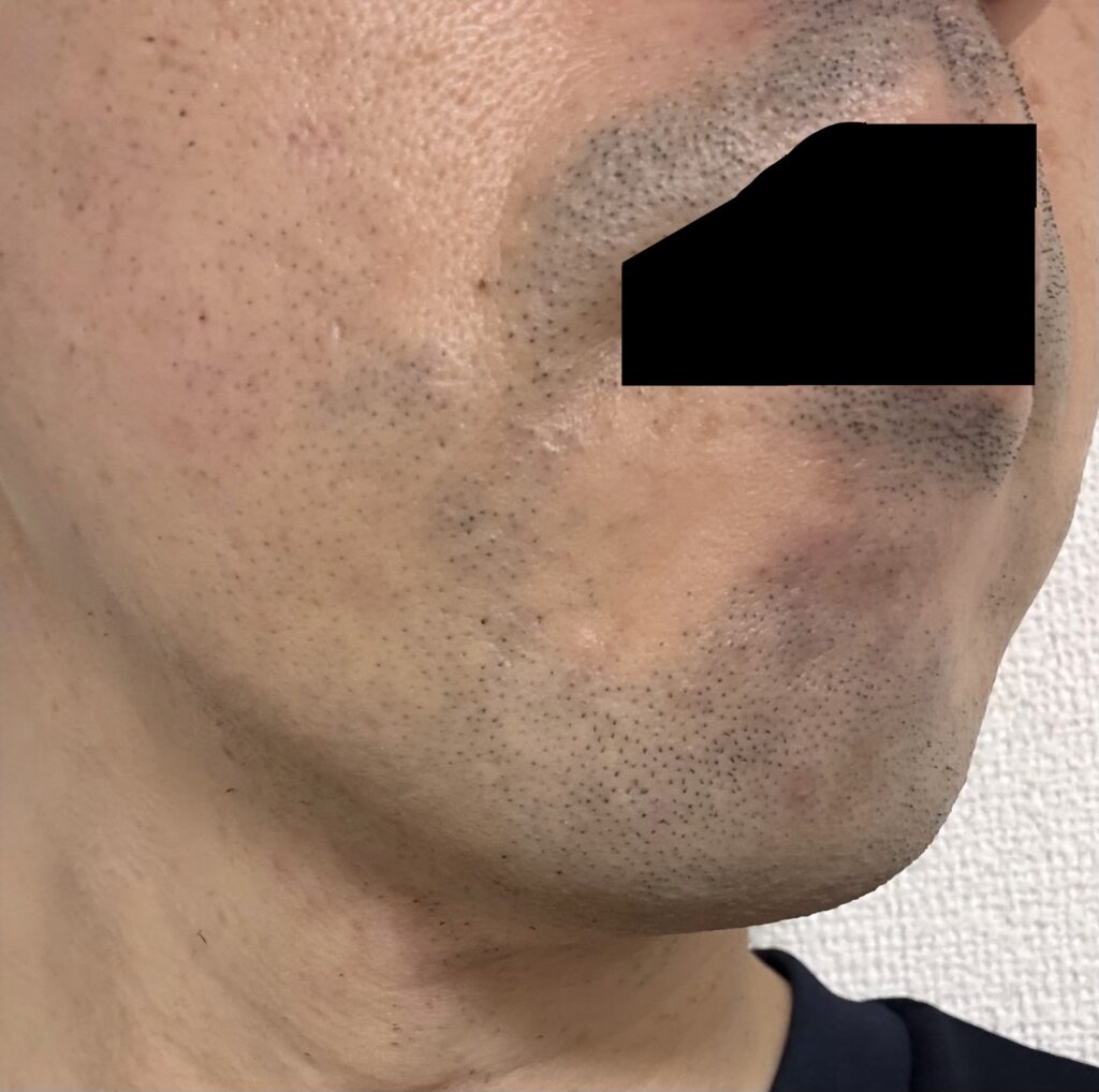 2回目の施術後 横